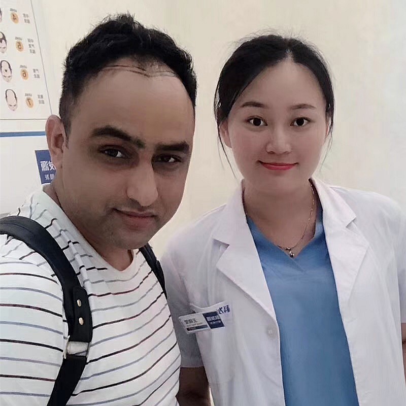 Happy FUE patient