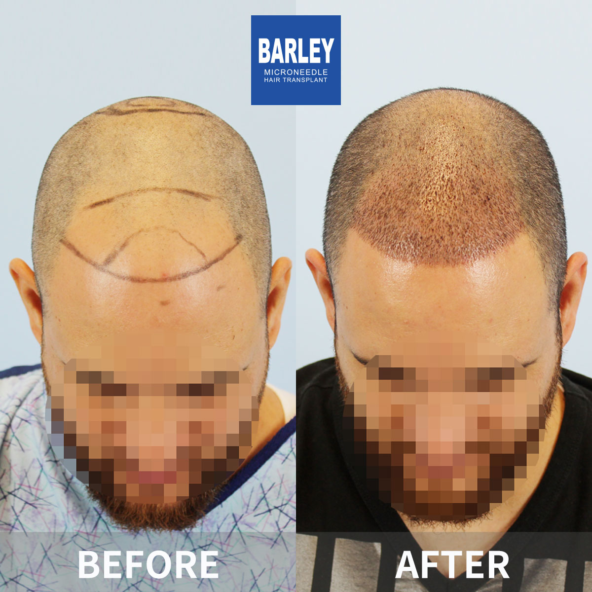 Baldness Restoration Result