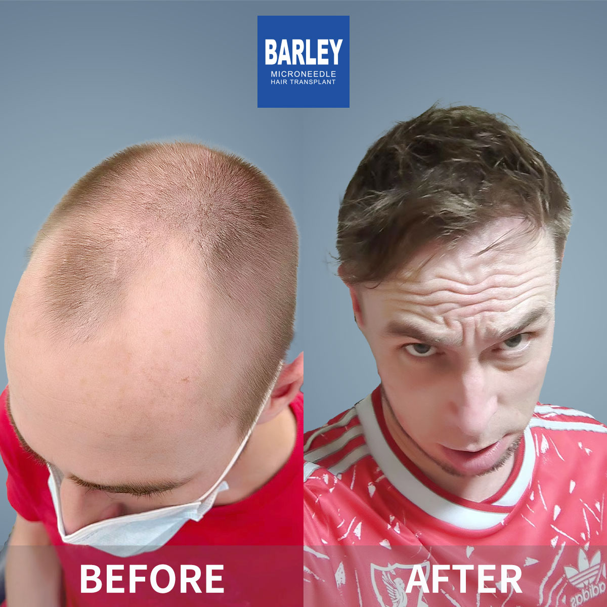 Baldness Restoration Result