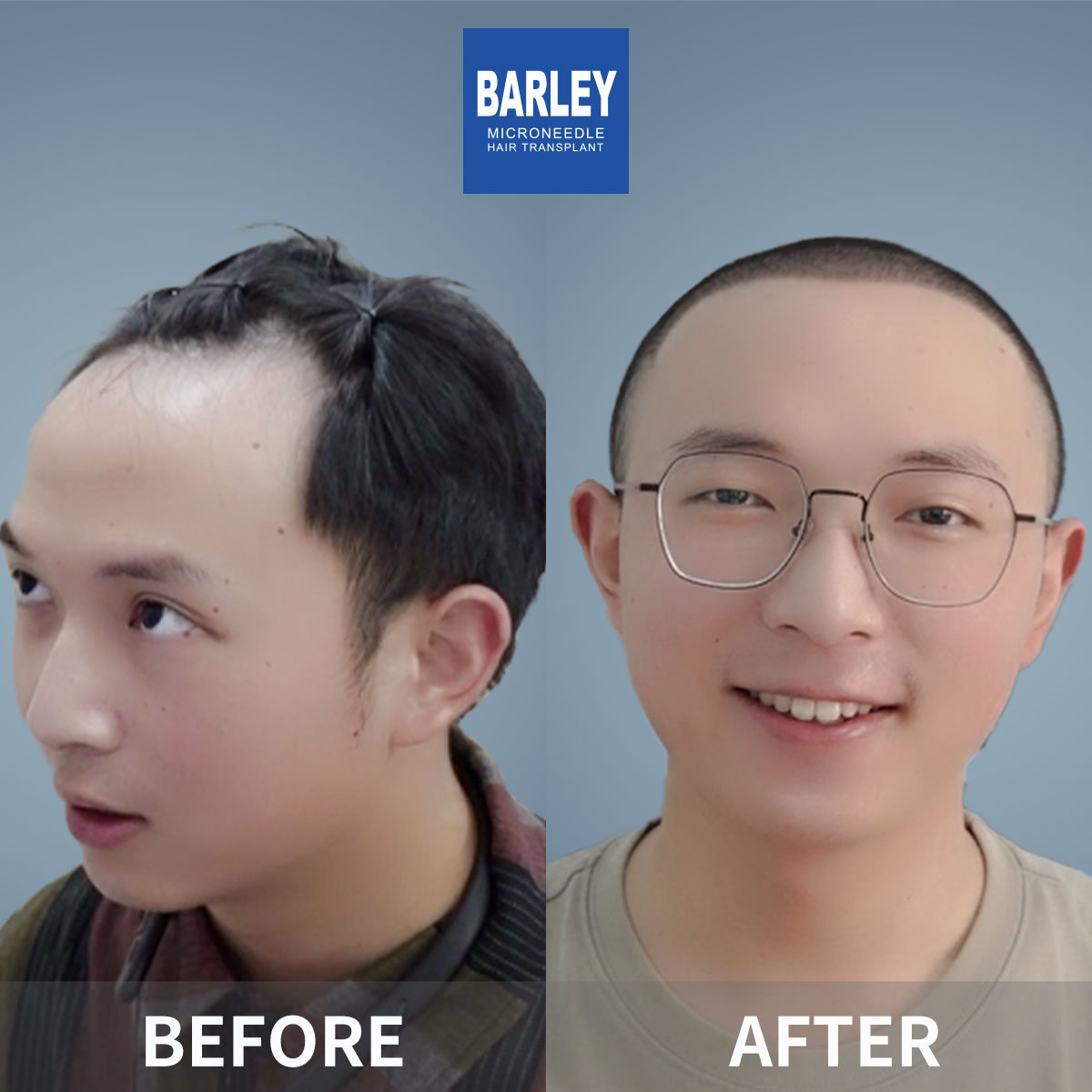 Hairline Transplant Result