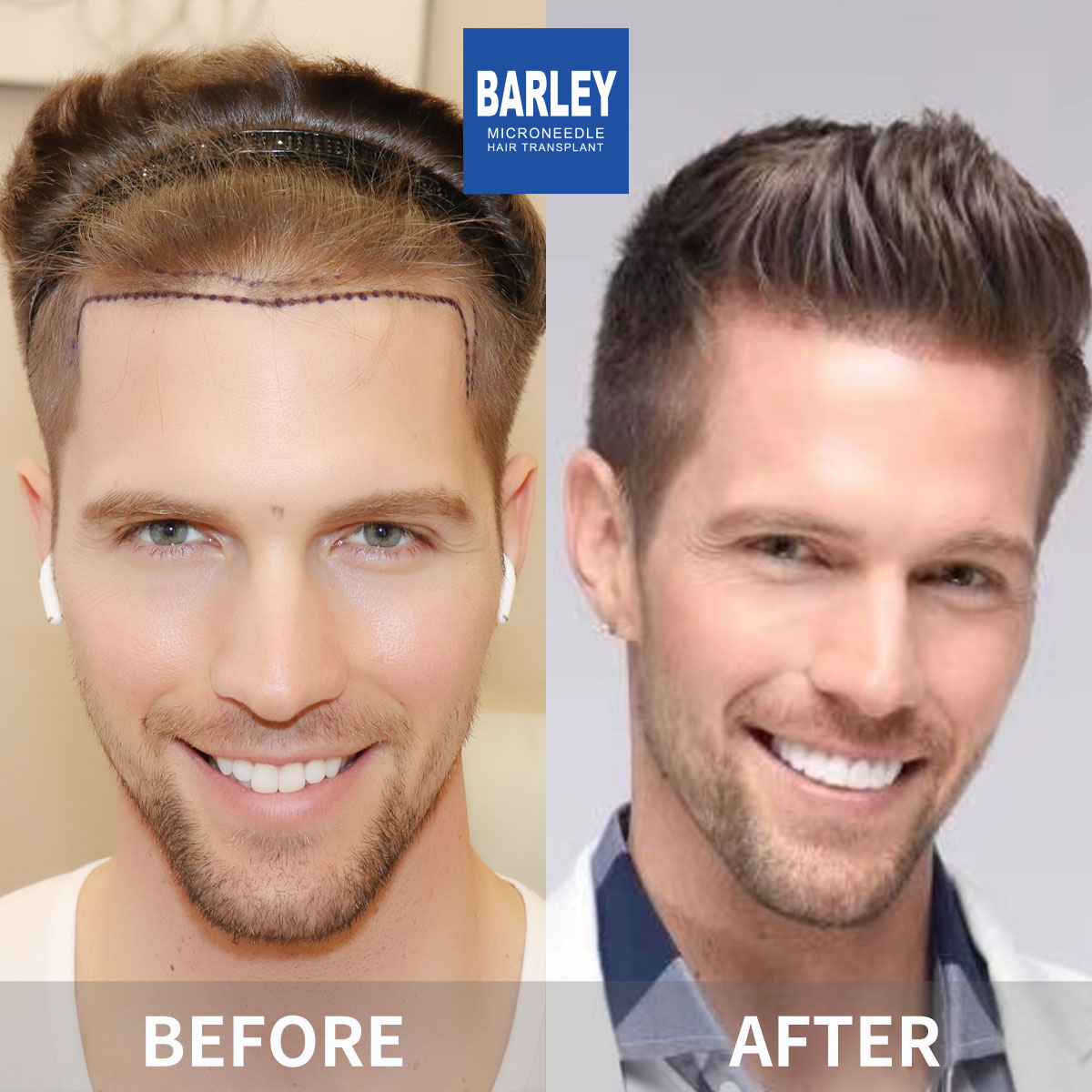 Hairline Transplant Result