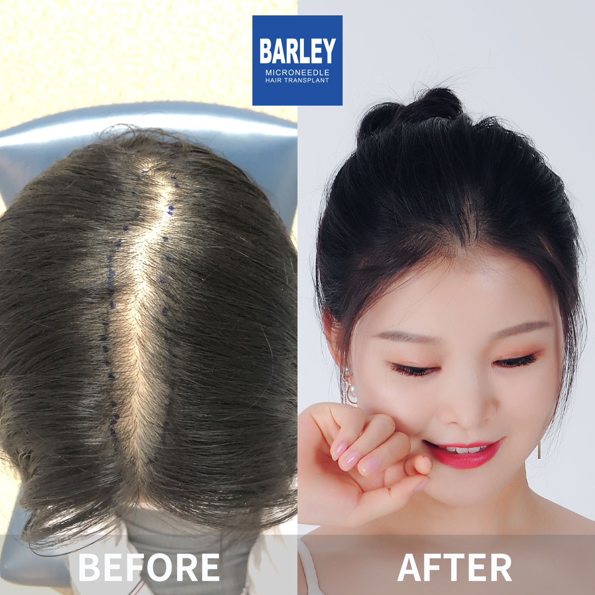 Women's Hairline Transplant Result