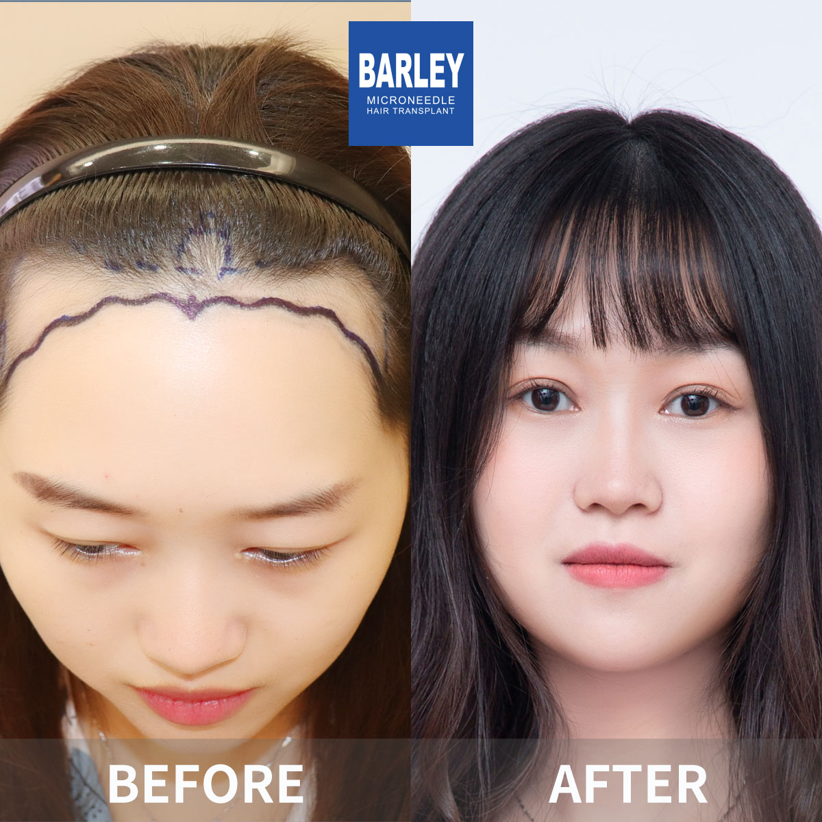 Women's Hairline Transplant Result